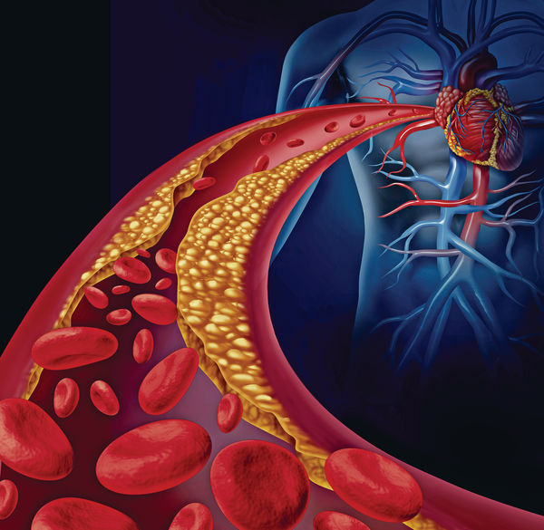 血栓病人可以补硒吗(硒对脑血栓有什么效果)-硒宝网