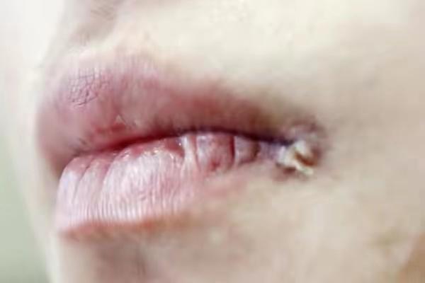 单纯疱疹补硒酵母片(单纯疱疹补硒酵母片)-硒宝网