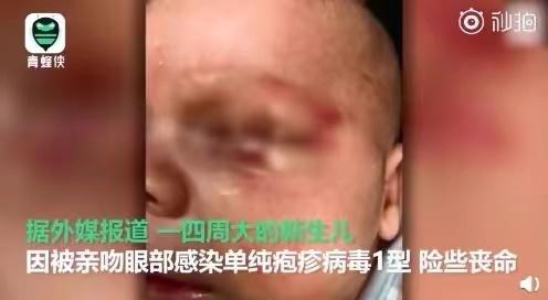 单纯疱疹补硒酵母片(单纯疱疹补硒酵母片)-硒宝网