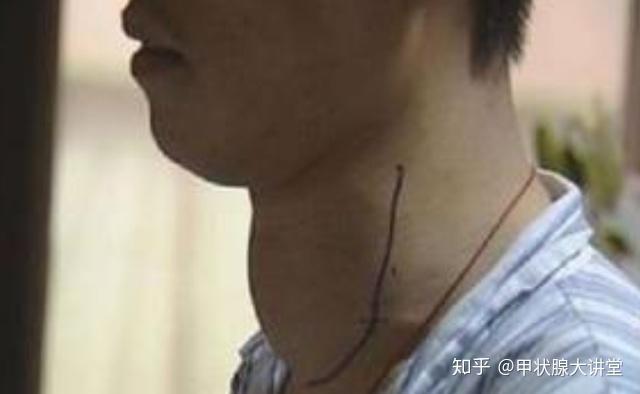 甲状腺结节3类补硒(甲状腺结节补充硒)-硒宝网