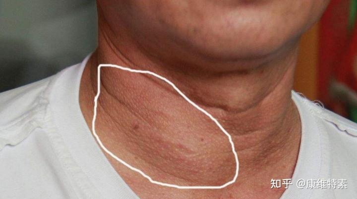 甲状腺结节3类补硒(补甲状腺结节类硒的药)-硒宝网