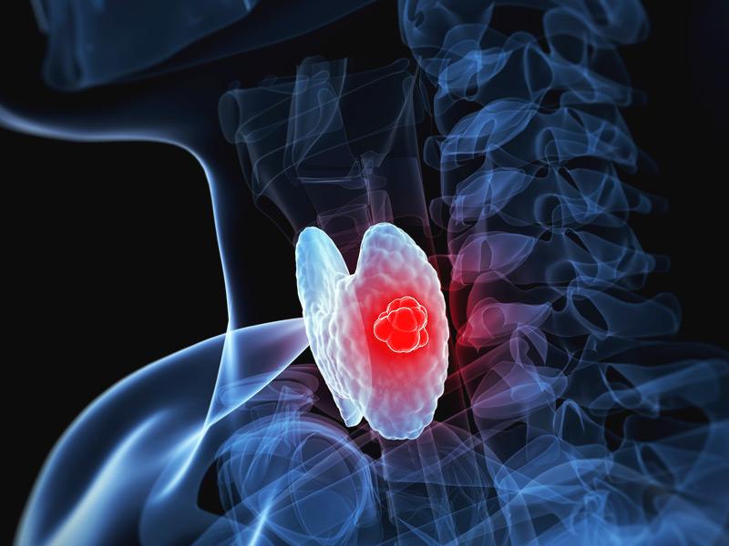 甲状腺肿瘤怎么补硒（肿瘤补甲状腺硒有用吗）-硒宝网