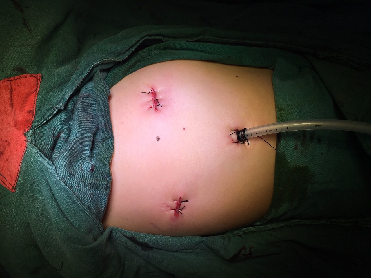 肺癌手术后不能补硒（肺癌手术后可以补硒吗）-硒宝网