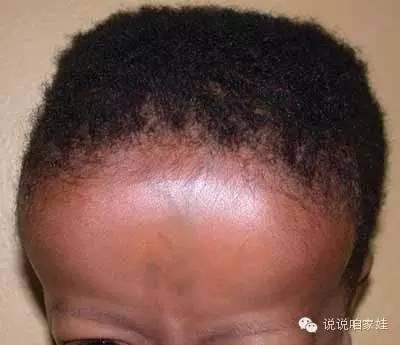 宝宝补钙多了有什么坏处(坏处补钙宝宝有什么危害)-硒宝网