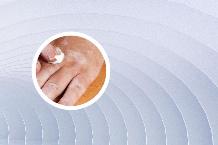 白癜风为什么要补硒（补硒能治疗乙肝吗）-硒宝网