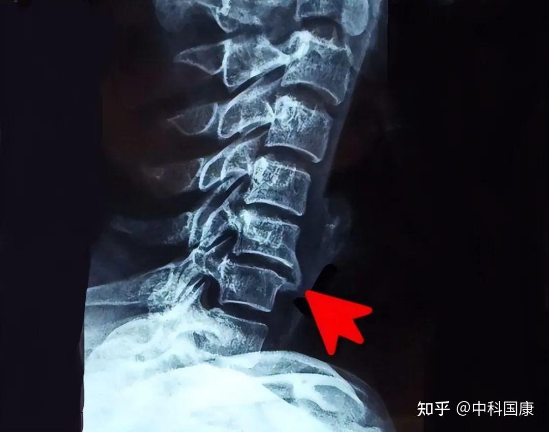 骨质增生能补钙吗（骨增生补钙有用吗）-硒宝网