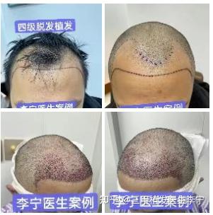 掉头发缺什么微量元素（缺微量掉头发元素是什么）-硒宝网