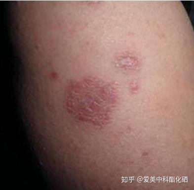 关节疾病补硒的作用（硒与关节）-硒宝网