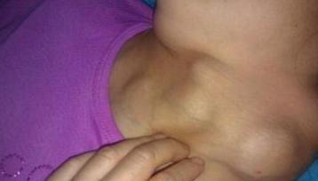 桥本甲亢需要补硒么(桥本氏甲状腺为什么要补硒)-硒宝网