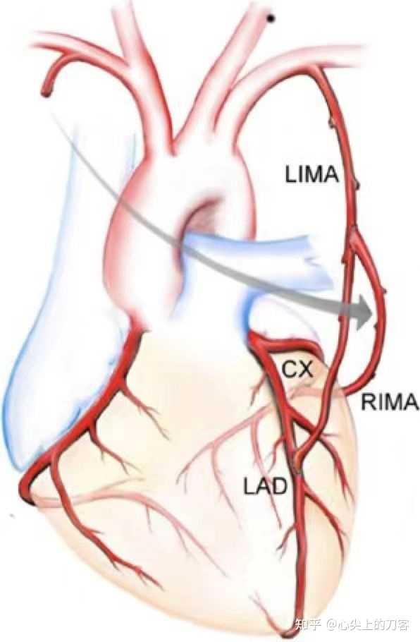 心脏搭桥可以补硒吗(心脏搭桥可以吃维生素c吗)-硒宝网