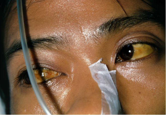 早期肺癌补硒多少克（肺癌补硒吃什么药）-硒宝网