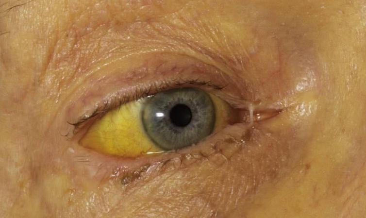 早期肺癌补硒多少克（肺癌补硒吃什么药）-硒宝网