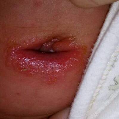 缺碘怎么补（甲亢是缺碘还是碘太多）-硒宝网