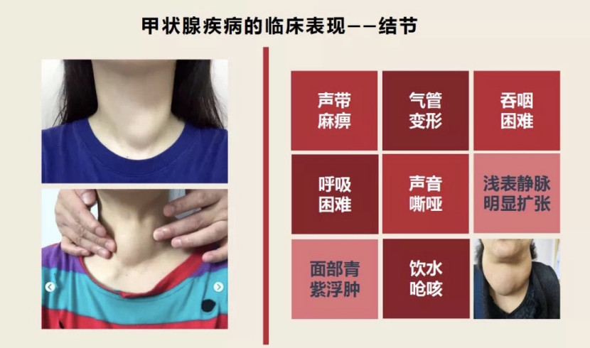 甲状腺结节要补硒吗（补甲状腺结节硒要吃多久）-硒宝网