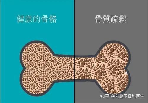 肾结石患者如何补钙（肾结石病人补钙）-硒宝网