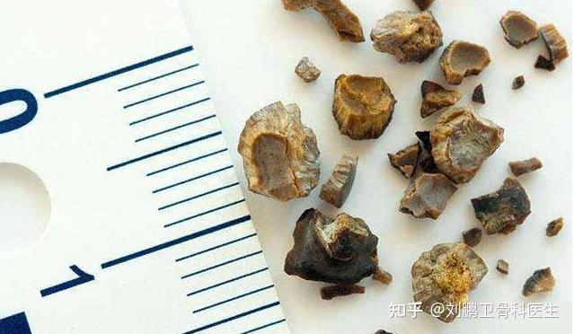 肾结石患者如何补钙（肾结石病人补钙）-硒宝网