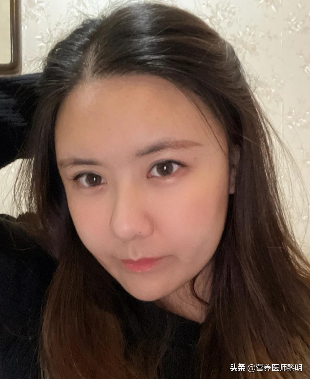 补硒后轻微甲亢好了(甲亢补硒补多久)-硒宝网