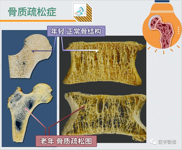 骨质疏松需要补钙吗（补钙骨质疏松）-硒宝网