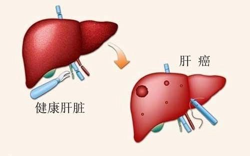 肝癌可以长期补硒吗（肝癌吃硒有效果吗）-硒宝网