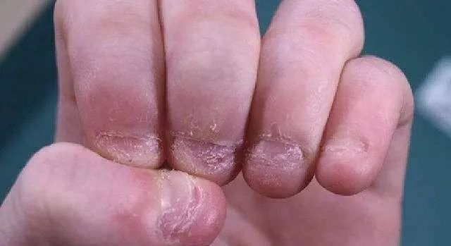 小孩咬指甲是缺什么微量元素(小孩啃指甲缺微量元素)-硒宝网