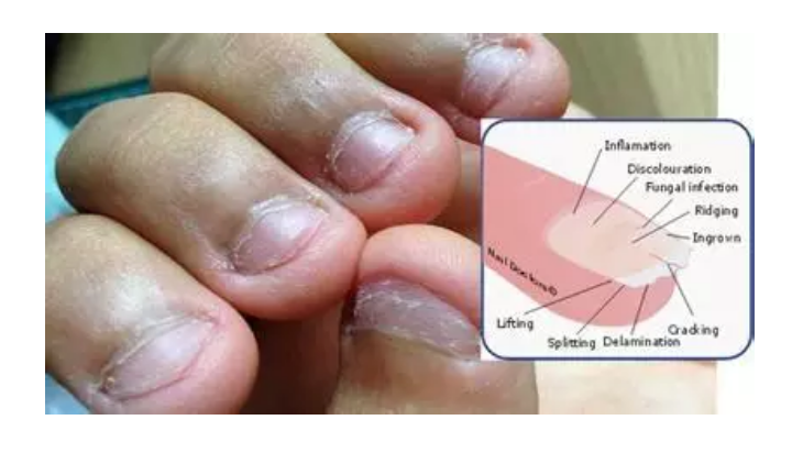 小孩咬指甲是缺什么微量元素(小孩啃指甲缺微量元素)-硒宝网