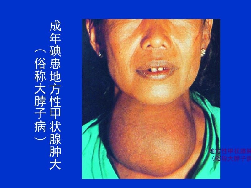 补碘的药（补碘的药）-硒宝网