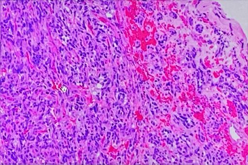 肺癌补硒食物有哪些(肺癌患者补硒有什么好处有用吗)-硒宝网