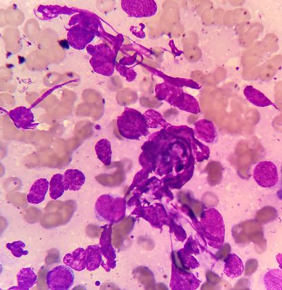 肺癌补硒食物有哪些(肺癌患者补硒有什么好处有用吗)-硒宝网