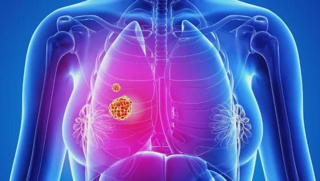 肺癌补硒食物有哪些(肺癌患者补硒有什么好处有用吗)-硒宝网