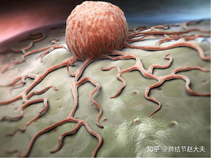 补硒能治疗肺部结节（硒与肺结节）-硒宝网