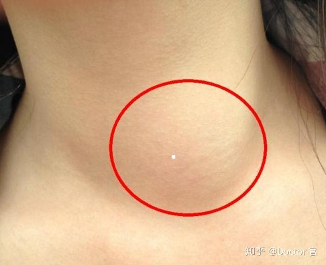 甲亢补硒食品有哪些（补食品甲亢硒有什么作用）-硒宝网