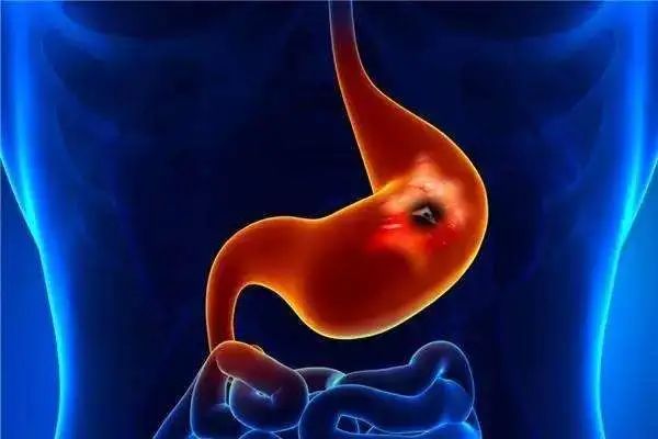 胃癌晚期补硒吃什么(晚期补胃癌吃硒片好吗)-硒宝网