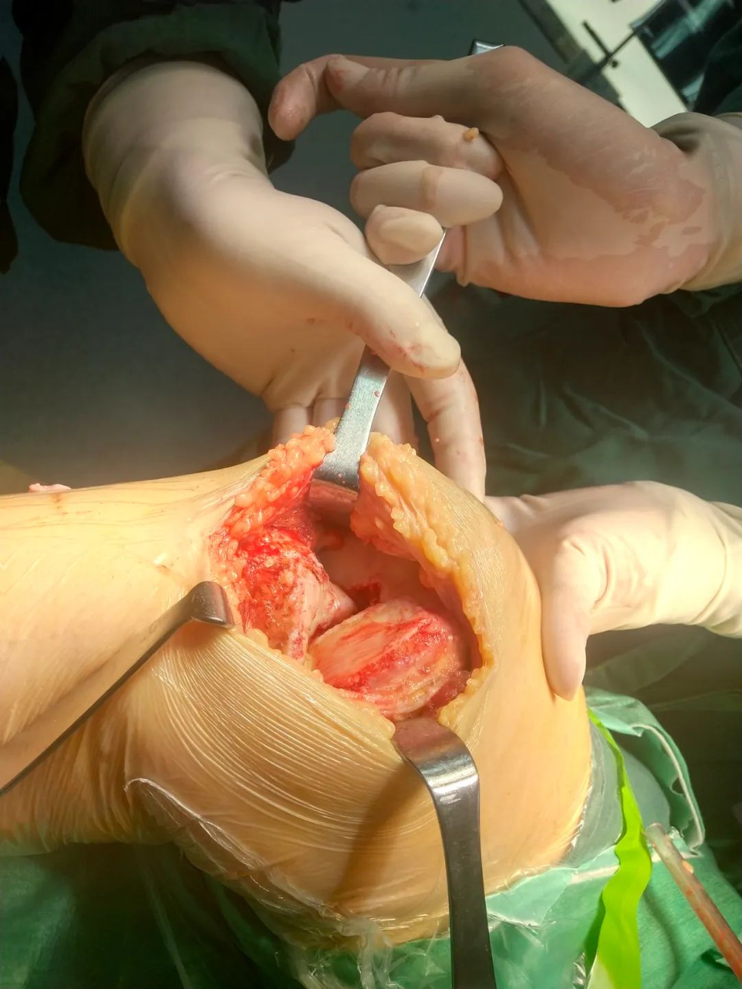 hpv52阳性补硒(hpv阳性补充硒会有效果吗)-硒宝网