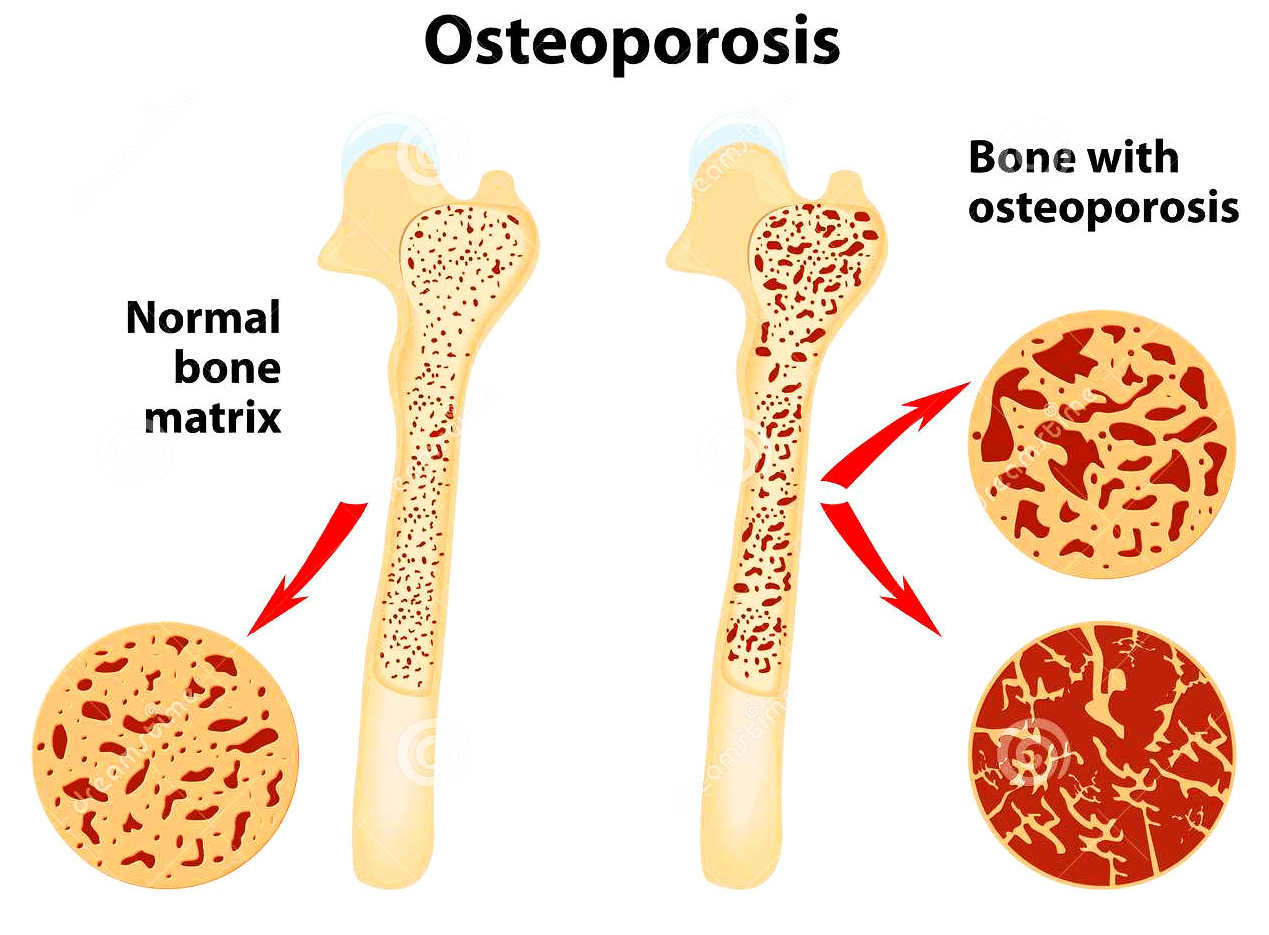 有补钙的针剂吗(补钙针剂有哪几种)-硒宝网