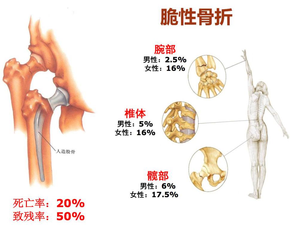 有补钙的针剂吗(补钙针剂有哪几种)-硒宝网