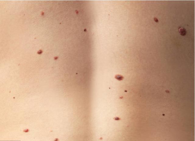 丙肝患者需要补硒吗(丙肝可以补硒吗)-硒宝网