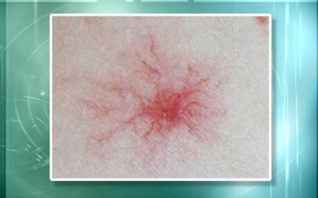 丙肝患者需要补硒吗(丙肝可以补硒吗)-硒宝网