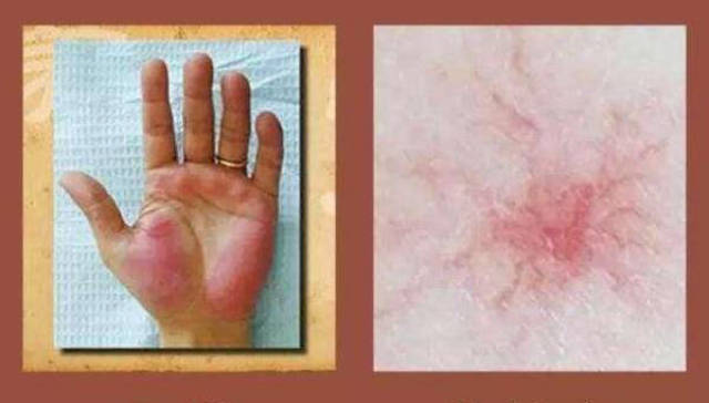 丙肝患者需要补硒吗(丙肝可以补硒吗)-硒宝网