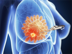 补硒对乳腺结节好吗(乳房有结节补硒管用吗)-硒宝网