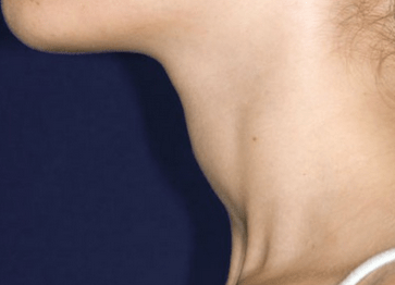 甲状腺功能不好补硒(补甲状腺功能好硒片有用吗)-硒宝网