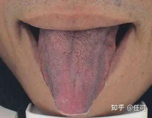 甲亢补硒治疗原则为(甲亢补硒的药)-硒宝网