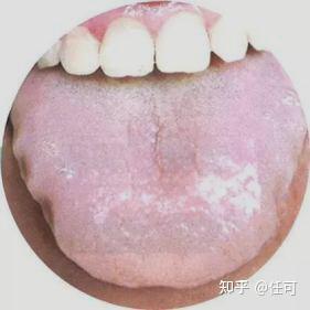 甲亢补硒治疗原则为(甲亢补硒的药)-硒宝网