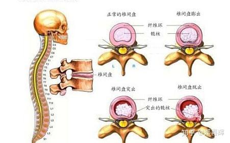 腰椎间盘突出能补钙吗(腰椎间盘突出能补钙么)-硒宝网