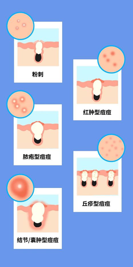 补硒过量引起胃溃疡(胃溃疡能补硒吗)-硒宝网