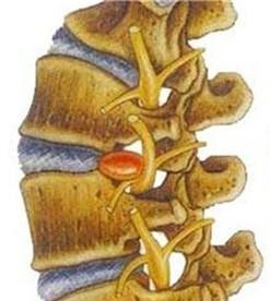 腰椎间盘突出可以补钙吗（腰间盘突出可以补钙吗药）-硒宝网