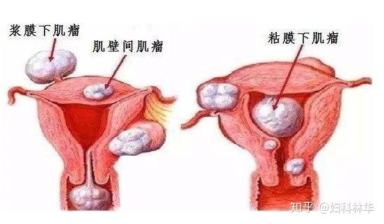 子宫肌瘤需要补硒嘛（子宫补肌瘤需要硒元素多少）-硒宝网