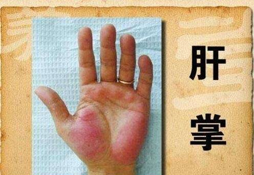 肝硬化是否需要补硒(肝硬化患者缺硒吗)-硒宝网