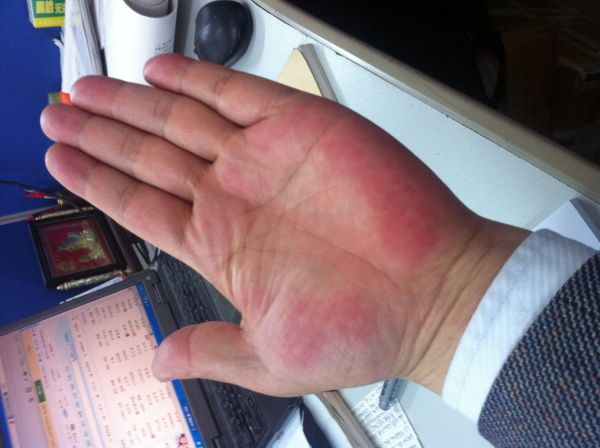 肝硬化是否需要补硒(肝硬化患者缺硒吗)-硒宝网