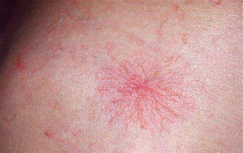 肝硬化是否需要补硒(肝硬化患者缺硒吗)-硒宝网