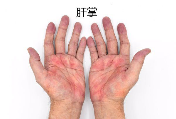 肝硬化是否需要补硒(肝硬化患者缺硒吗)-硒宝网